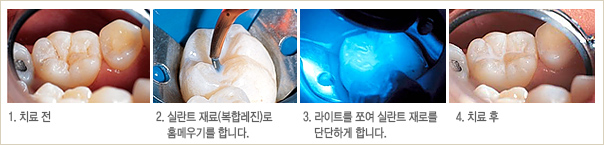유림치과병원 일반치료 : 실란트치료방법사진(1.치료전 → 2.실란트재료로 홈메우기를 합니다. → 3.라이트를 쪼여 실란트 재료를 단단하게 합니다. → 4.치료 후) 