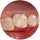 유림치과병원 One-day치료 : step5. 구강 내 장착